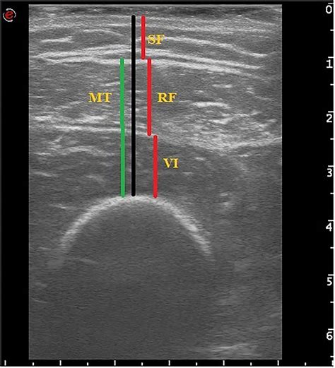 The value of ultrasound measurement of muscle thickness at 